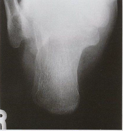 Proyección Axial del Calcáneo - Vista anatómica
